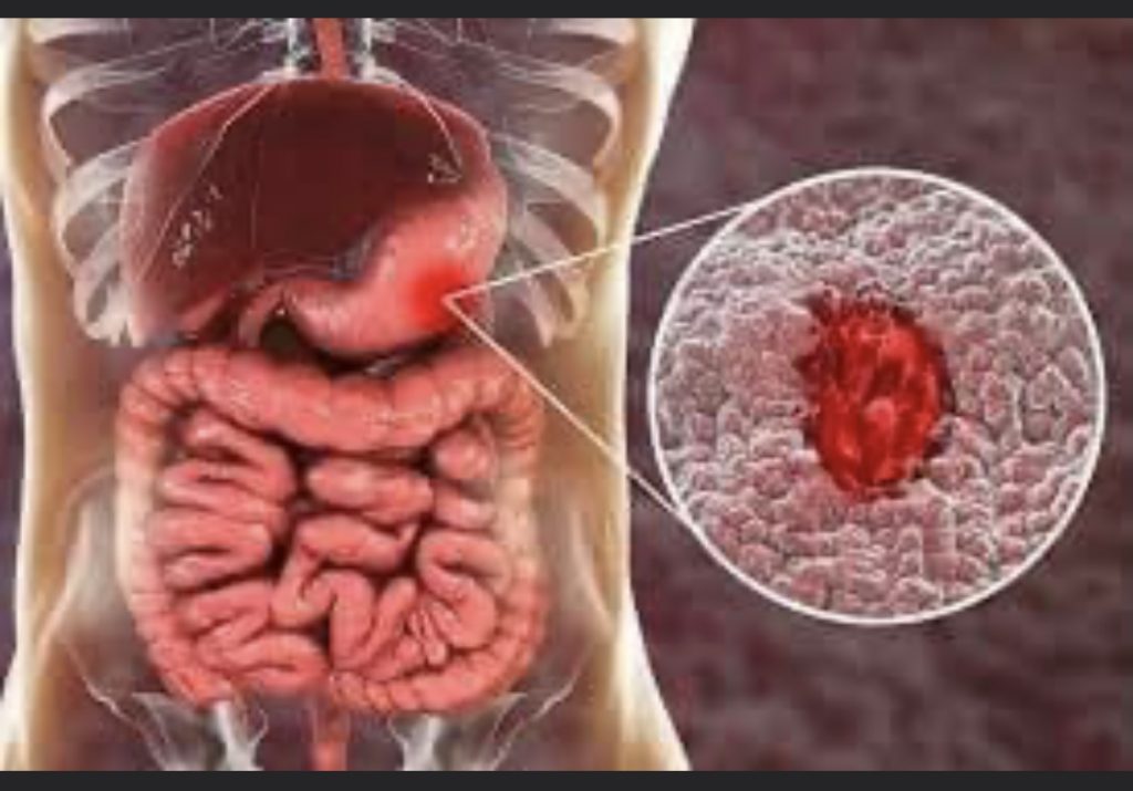 தீராத வயிற்றுப் புண்ணை(அல்சர்) குணமாக்கும் வழிமுறைகள்.