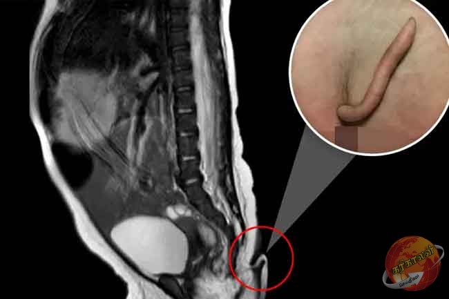 வாலுடன் பிறந்த குழந்தை! மருத்துவ உலகில் அதிசயம்-Karihaalan news