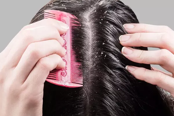 மழைக்காலத்தில் உங்கள் தலைமுடிகளுக்கு ஏற்படும் 3 பிரச்சனைகள்: எப்படி தடுக்கலாம்?