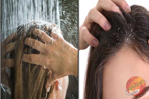 பொடுகு தொல்லைக்கு நிரந்தர தீர்வு வேண்டுமா? அப்போ இந்த வீட்டு வைத்தியம் போதும்