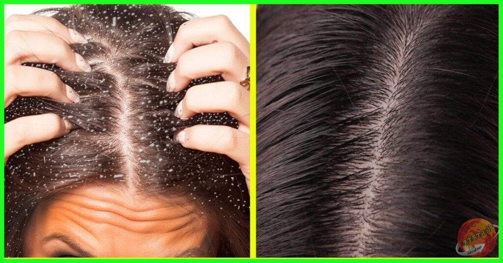 பொடுகு தொல்லை அதிகம் இருக்கா? இதை மட்டும் செய்திடுங்கள்