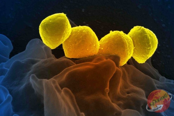 ஜப்பான் பக்டீரியாவால் இலங்கை உட்பட பல நாடுகள் ஆபத்தில்