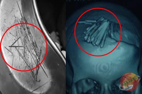 இந்தியாவில் பெண்ணின் தலையில் ஏற்றப்பட்ட 77 ஊசிகள்: 4 ஆண்டுகளுக்கு பிறகு வெளிவந்த உண்மை