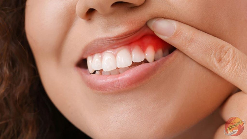 வாய் புற்று நோயால் நாளொன்றுக்கு மூன்று மரணங்கள் பதிவு